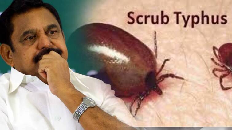 edappadi palanisamy warning about rikkatshiya bacteria in tamilnadu இதுவரை 600 பேர்! தமிழ்நாட்டில் புதிதாக பரவும் பாக்டீரியா தொற்று – எச்சரிக்கும் எடப்பாடி பழனிசாமி!