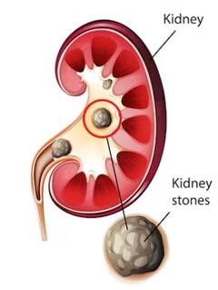 ਅਚਾਨਕ ਬਹੁਤ ਜ਼ਿਆਦਾ ਭਾਰ ਵਧਣਾ, ਗੁਰਦੇ ਵਾਲੀ ਥਾਂ 'ਤੇ ਭਾਰੀਪਨ ਮਹਿਸੂਸ ਹੋਣ ਵਰਗੇ ਲੱਛਣ ਦਿੰਦੇ Kidney Failure ਦੀ ਚੇਤਾਵਨੀ