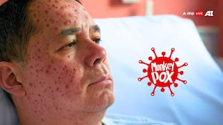 दुबई से लौटे शख्स में मिला Mpox, जान लीजिए इसके लक्षण और बचाव का तरीका