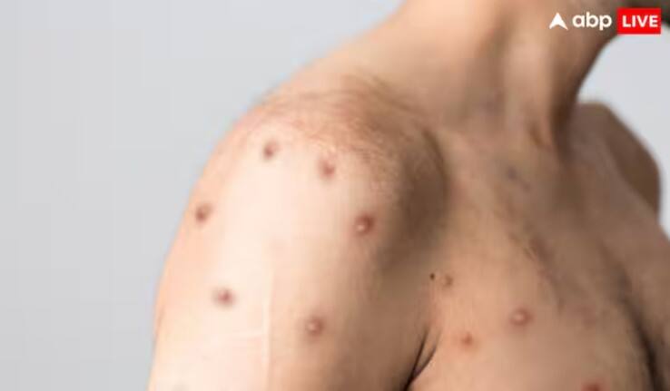 Monkey pox new case reported in karnataka after dubai travel confirmed virus infection   Monkey Pox New Case: સાવધાન! દેશમાં મંકીપોક્સનો પ્રથમ કેસ, સ્વાસ્થ્ય વિભાગે જાહેર કરી ચેતવણી  