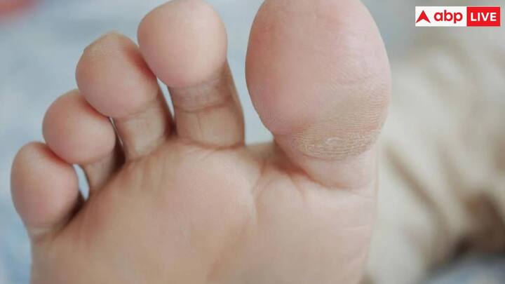 हालांकि यह असामान्य लग सकता है. लेकिन दूसरे पैर का लंबा होना कोई चिकित्सा स्थिति नहीं है और यह केवल पैर के आकार में बदलाव है.