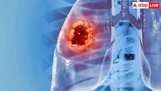 Lung Cancer Symptoms: लंग्स कैंसर होने पर शरीर पर दिखने लगते हैं ये लक्षण, बिल्कुल न करें नजरअंदाज