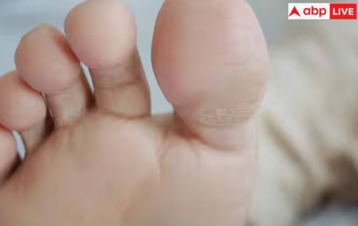 ਅਜਿਹਾ ਇਸ ਲਈ ਹੁੰਦਾ ਹੈ ਕਿਉਂਕਿ ਦੂਜੀ ਮੈਟਾਟਾਰਸਲ ਹੱਡੀ (ਉਹ ਹੱਡੀ ਜੋ ਦੂਜੇ ਪੈਰ ਦੇ ਅੰਗੂਠੇ ਨੂੰ ਤੁਹਾਡੇ ਪੈਰ ਨਾਲ ਜੋੜਦੀ ਹੈ) ਕੁਦਰਤੀ ਤੌਰ 'ਤੇ ਪਹਿਲੀ ਮੈਟਾਟਾਰਸਲ ਹੱਡੀ ਨਾਲੋਂ ਲੰਬੀ ਹੁੰਦੀ ਹੈ। ਜੋ ਤੁਹਾਡੇ ਵੱਡੇ ਪੈਰ ਦੇ ਅੰਗੂਠੇ ਨਾਲ ਜੁੜਦੀ ਹੈ, ਜਿਸ ਨਾਲ ਦੂਜੇ ਪੈਰ ਦਾ ਅੰਗੂਠਾ ਲੰਬਾ ਦਿਖਾਈ ਦਿੰਦਾ ਹੈ। ਹਾਲਾਂਕਿ ਇਹ ਅਸਾਧਾਰਨ ਲੱਗ ਸਕਦਾ ਹੈ। ਪਰ ਦੂਜੀ ਲੱਤ ਦਾ ਲੰਬਾ ਹੋਣਾ ਕੋਈ ਡਾਕਟਰੀ ਸਥਿਤੀ ਨਹੀਂ ਹੈ ਅਤੇ ਇਹ ਸਿਰਫ਼ ਲੱਤ ਦੇ ਆਕਾਰ ਵਿੱਚ ਤਬਦੀਲੀ ਹੈ।