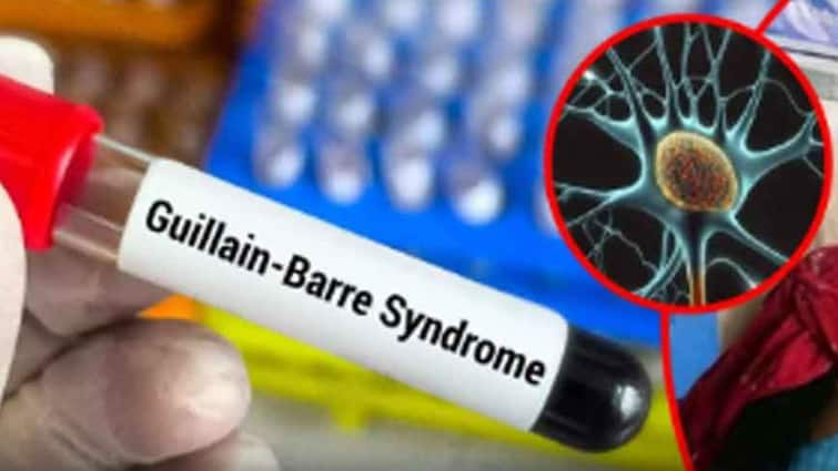 Guillain Barre Syndrome: 149 Suspected Patients, 5 Dead And 28 On Ventilator