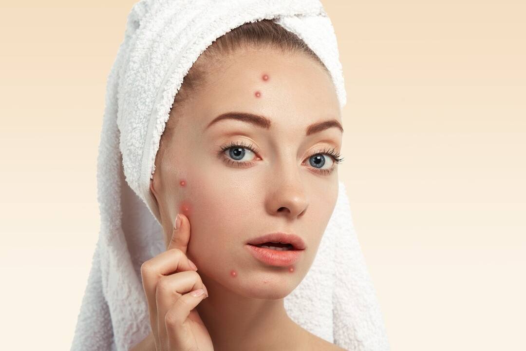 Beauty care Tips: આપને ખીલની સમસ્યા સતાવે છે તો જાણો કારણો અને ઉપાય If you are suffering from acne problem, then know the causes and remedies. Beauty care Tips: આપને ખીલની સમસ્યા સતાવે છે તો જાણો કારણો અને ઉપાય