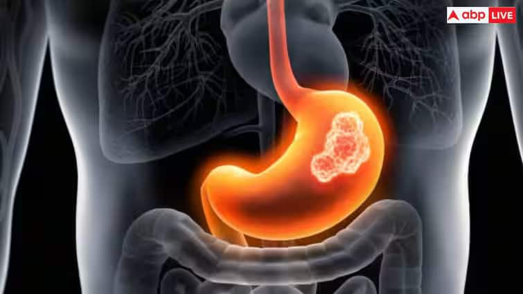 health Tips cells-grow-rapidly-and-eventually-form-a-tumor-cause-stomach-cancer Health Tips: તમારા પેટમાં તો નથી બની રહ્યાને કેન્સરના કોષો? આ લક્ષણોથી કરી શકો છો ઓળખ