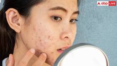 Myths Vs Facts: चेहरे पर पिंपल्स दिखते ही फोड़ देते हैं आप? जान लीजिए ये कितना सही