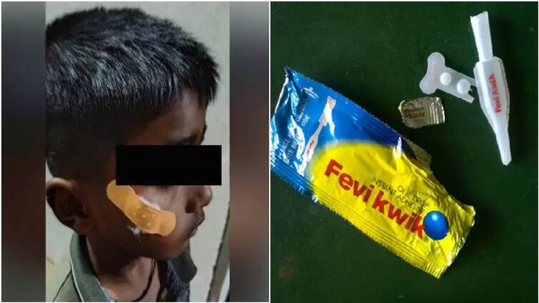 Karnataka nurse uses Fevikwik to seal child's face cut faces inquiry அடப்பாவிகளா! காயத்திற்கு பெவிகால் போட்ட நர்ஸ்! சிறுவனுக்கு நிகழ்ந்த சோகம்