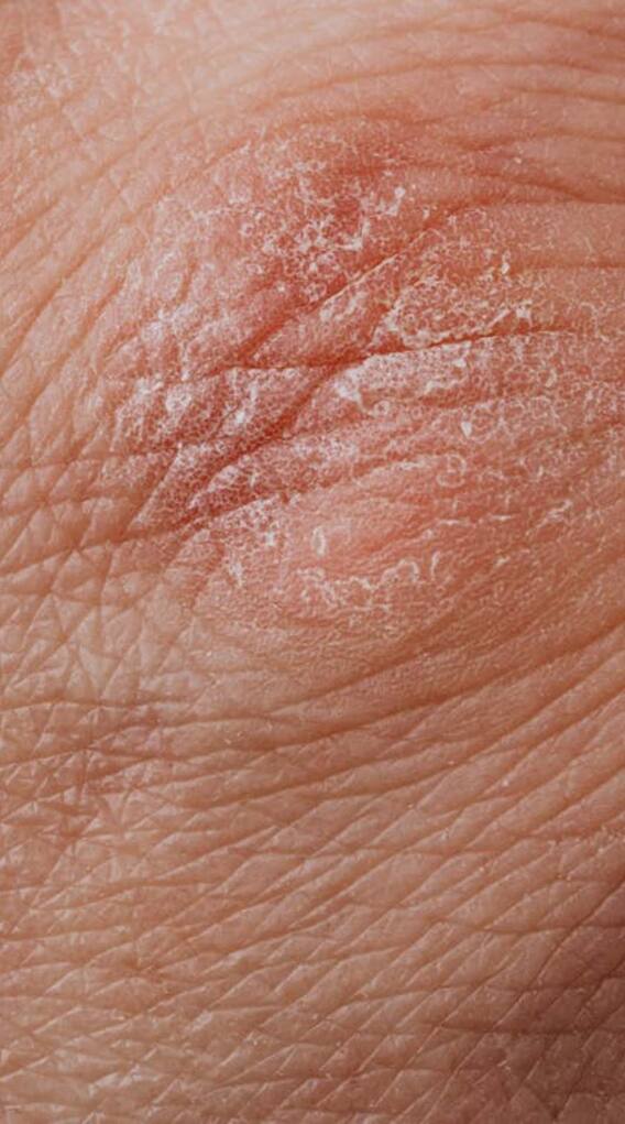 क्या होती है सोरायसिस, कैसे कर सकते हैं कंट्रोल