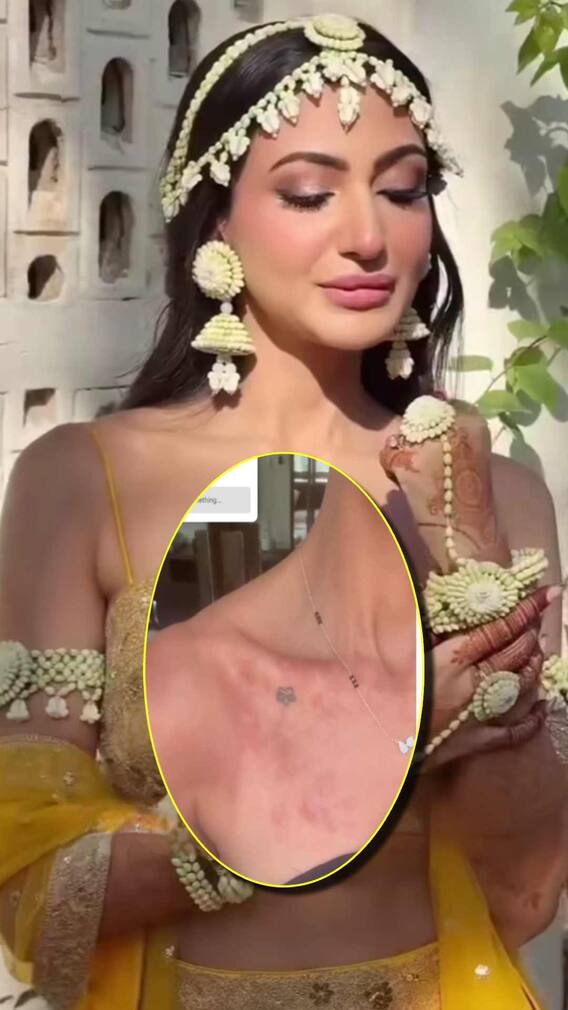 शादी के 3 दिन बाद ही मुश्किल में प्रियंका चोपड़ा की भाभी, बॉडी पर आए ऐसे निशान