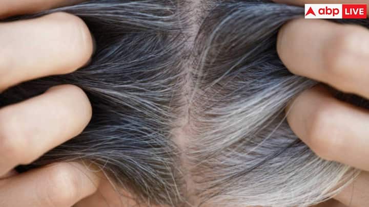 जब शरीर में पोषक तत्व की कमी होती है. जैसे विटामिन बी12, आयरन या कॉपर की कमी, तनाव, थायरॉयड की समस्या के कारण भी बाल सफेद होने लगते हैं. कई बार कुछ मेडिकल रीजन के कारण भी बाल सफेद होने लगते हैं. प्रदूषण के कारण बाल अक्सर सफेद हो जाते हैं.