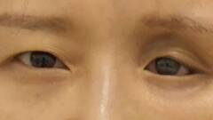 डॉक्टरों को महिला की आंख के पीछे खोए हुए पांच कॉन्टैक्ट लेंस मिले, हैरान कर देगी खबर