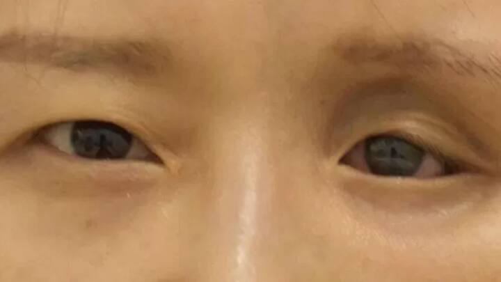 एक महिला रोगी, अपने चेहरे में सुधार के लिए अपने हेमीफेशियल एट्रोफी का इलाज कराने के लिए बीजिंग में चीनी चिकित्सा विज्ञान अकादमी के प्लास्टिक सर्जरी अस्पताल में आई थी.