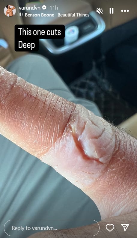 Varun Dhawan की उंगली में लगी चोट, एक्टर ने फैंस संग शेयर किया दर्द, लिखा- 'जख्म गहरा है