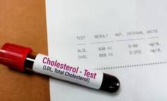 શરીરમાં વધતા કોલેસ્ટ્રોલના લક્ષણો શરીરના આ ભાગમાં મળે છે જોવા, ના કરતા નજરઅંદાજ