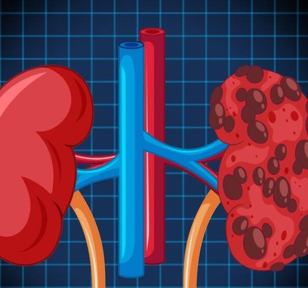 ਜਦੋਂ ਗੁਰਦੇ ਸਰੀਰ ਵਿੱਚ ਮੌਜੂਦ ਵਾਧੂ ਪਾਣੀ ਨੂੰ ਕੱਢਣ ਵਿੱਚ ਅਸਮਰੱਥ ਹੁੰਦੇ ਹਨ, ਤਾਂ ਇਹ ਸਰੀਰ ਵਿੱਚ ਇਕੱਠਾ ਹੋ ਜਾਂਦਾ ਹੈ, ਜਿਸ ਨਾਲ ਲੱਤਾਂ ਵਿੱਚ ਸੋਜ ਅਤੇ ਅੱਖਾਂ ਦੇ ਆਲੇ-ਦੁਆਲੇ ਸੋਜ ਆ ਜਾਂਦੀ ਹੈ।