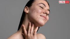 क्या आपके भी मुंह के आसपास है हाइपरपिग्मेंटेशन? काले धब्बों से छुटकारा पाने के लिए घरेलू उपाय