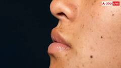 क्या आपके भी मुंह के आसपास है हाइपरपिग्मेंटेशन? काले धब्बों से छुटकारा पाने के लिए घरेलू उपाय