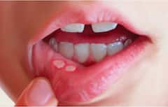 Health Tips: મોઢામાં પડતા સફેદ ચાંદા હોઈ શકે છે આ ગંભીર સ્થિતિની નિશાની, ભૂલથી પણ તેને અવગણશો નહીં