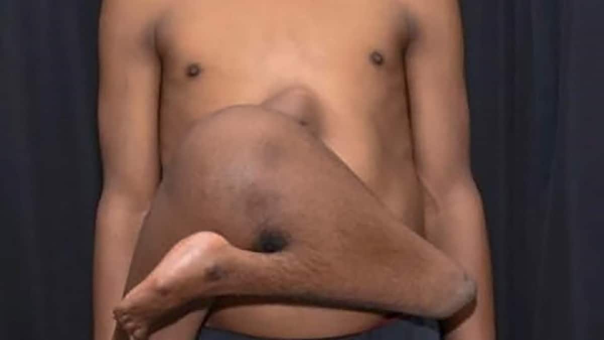 Delhi AIIMS Doctors Perform Rare Surgery To Separate 'Parasitic Twin' From 17-Year-Old