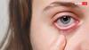 Eye Flu in India : 1-2 नहीं 5 तरह के होते हैं आई फ्लू, जान लें लक्षण और बचाव
