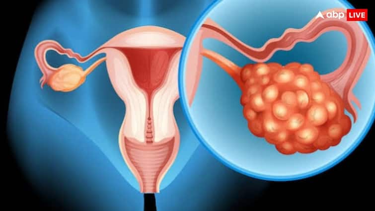 This cancer takes the lives of thousands of women each year, he does not know his symptoms