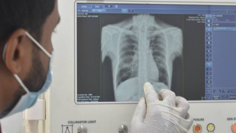 AI powered x ray machines helping in early TB detection lakhs of patient benefited AI से चलने वाली मशीनें बन रहीं गेमचेंजर, TB की जल्दी पहचान में आ रहीं काम, लाखों मरीजों को फायदा