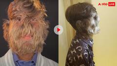 इंसान है या भालू? इस खतरनाक सिंड्रोम से जूझ रहे भारतीय लड़के ने बनाया अनोखा वर्ल्ड रिकॉर्ड, जानकर सिर पकड़ लेंगे आप