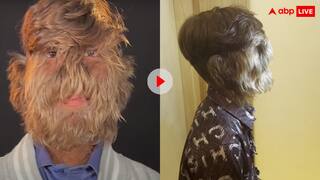 इंसान है या भालू? इस खतरनाक सिंड्रोम से जूझ रहे भारतीय लड़के ने बनाया अनोखा वर्ल्ड रिकॉर्ड, जानकर सिर पकड़ लेंगे आप