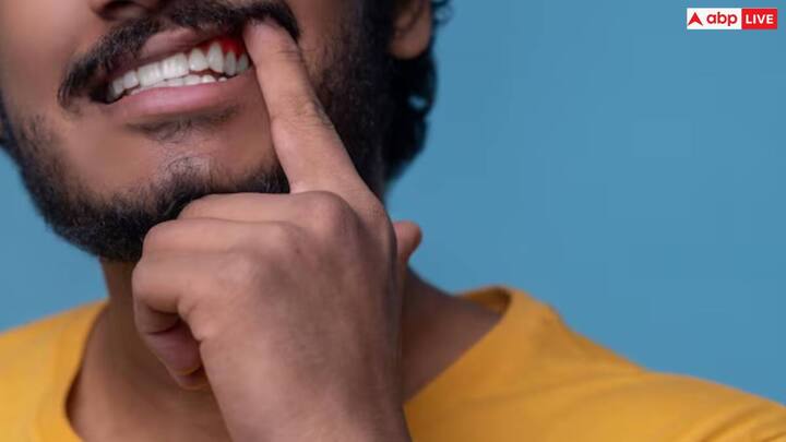 बेकिंग सोडा और नींबू का रस: आप अपने दांतों को सफ़ेद करने के लिए बेकिंग सोडा और नींबू के रस का भी इस्तेमाल कर सकते हैं. इसके लिए आपको बेकिंग सोडा में नींबू का रस मिलाना है. इससे नियमित मालिश करने से आपके दांतों पर जमा पीलापन दूर हो सकता है.