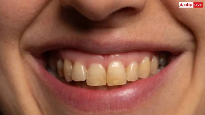 अगर आपके दांत पीले हो गए हैं और इस वजह से आप खुलकर हंस नहीं पाते और मुस्कुरा नहीं पाते तो यह लेख आपके बहुत काम आने वाला है. आप इस ट्रिक्स अपनाकर तुरंत मोती जैसे दांत पा सकते हैं.