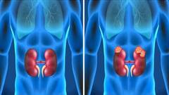 જીવલેણ બની શકે છે કિડની કેન્સર, તમે તો નજરઅંદાજ નથી કરતા છે આ સાયલન્ટ લક્ષણો