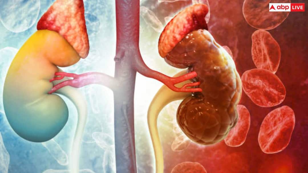 Early signs of kidney failure can include persistent fatigue read full article in hindi Kidney Failure Symptoms: किडनी फेल होने के यह है शुरुआती संकेत, बिल्कुल न करें नजरअंदाज