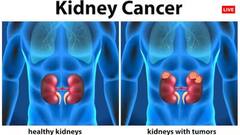 Cancer: જીવલેણ બની શકે છે કિડની કેન્સર, ક્યાંક તમે તો નથી કરી રહ્યાં ને આ લક્ષણોની અવગણના