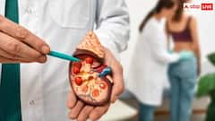 इन कारणों से किडनी में बनने लगते हैं पथरी, हेल्थ एक्सपर्ट ने बताया इसके शुरुआती संकेत