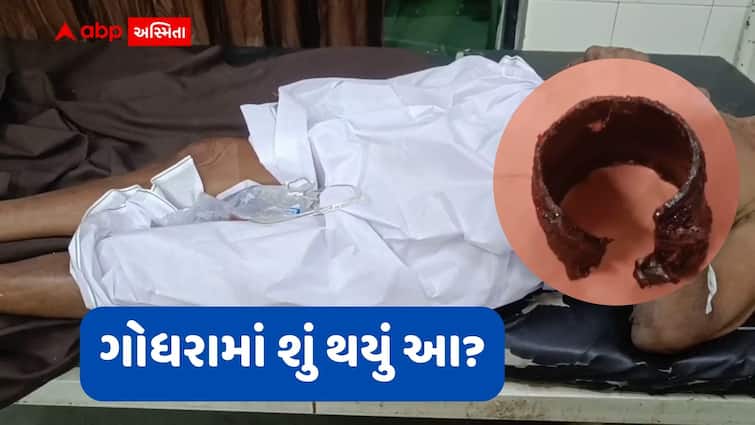 Godhra Shocker, Elderly Man Gets Plastic Bottle Cap Stuck in Private Parts ગોધરામાં વિચિત્ર ઘટના: 72 વર્ષના વૃદ્ધના પ્રાઇવેટ પાર્ટમાં કોઈએ ઢાંકણું ફસાવી દીધું, હોસ્પિટલ લઈ જતા...