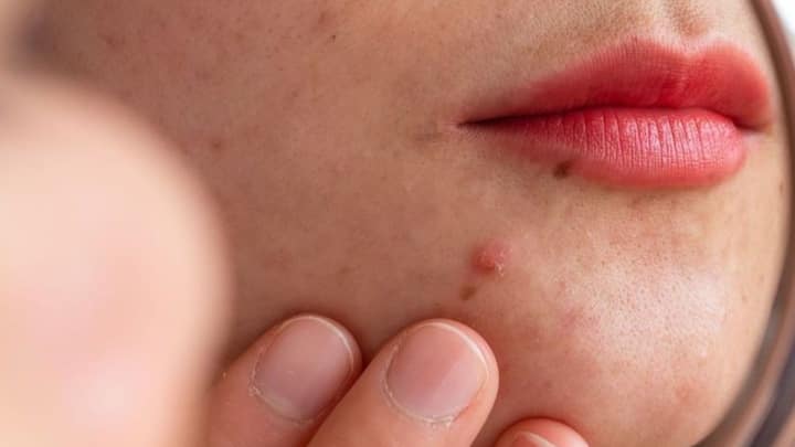 8. Acne Treatment: Aloe Vera has antibacterial and anti inflammatory properties that reduces breakouts. Applying aloe vera gel overnight on pimples to reduce swelling, fight bacteria, and fade away acne scars. It naturally keeps the skin calm and irritation free. (Image Source: Pinterest/healthbeauty252)
