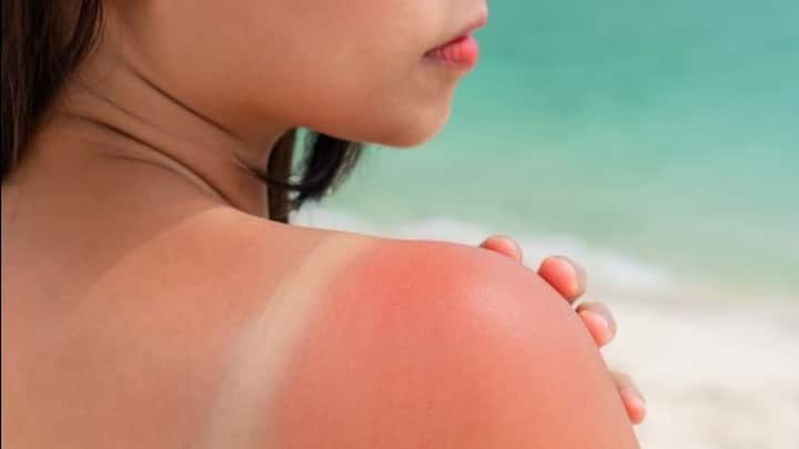 4. Sunburn Relief: Aloe Vera has cooling properties that helps soothe sunburns instantly. A generous layer of pure aloe vera gel will provide relief from redness, irritation, and peeling. It will speed up the healing process and deeply hydrate the sun damages skin. (Image Source: Pinterest/popsugar)