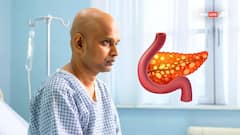लाइफस्टाइल से जुड़ी इन गलतियों के कारण बढ़ता है पैनक्रियाटिक कैंसर का खतरा, जानें कारण