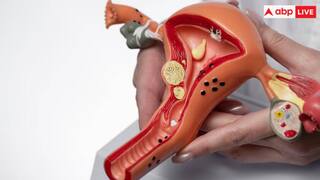 एंडोमेट्रियोसिस क्या है? किस उम्र में महिलाओं को इस बीमारी का रहता है खतरा