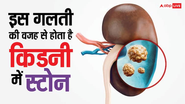 किडनी में पथरी होने के ये हैं सबसे बड़े कारण, कहीं आप भी तो नहीं कर रहे गलती?