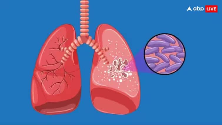 world tuberculosis day 2025 tb signs symptoms and prevention in tamil Tuberculosis: காசநோய் எனும் எமன்..! ஆண்டுக்கு 3.2 லட்சம் பேர் மரணம், அறிகுறிகள் என்ன? தடுப்பது எப்படி?