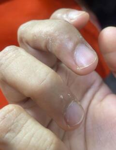 Skin Care Tips: ਨਹੁੰਆਂ ਦੇ ਆਲੇ-ਦੁਆਲੇ ਕਿਉਂ ਉਤਰਨ ਲੱਗ ਪੈਂਦਾ ਮਾਸ! ਇੰਝ ਪਾਓ ਰਾਹਤ