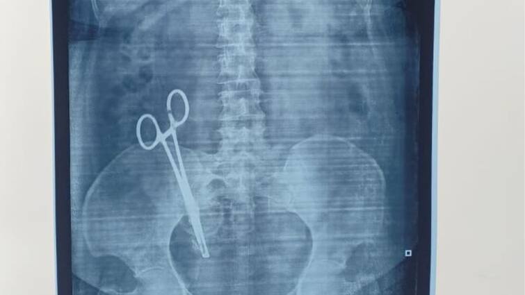 Scissors left in woman’s stomach detected after 17 years Gross medical negligence Scissor in Stomach: இப்படி ஒரு டாக்டரா..! உ.பி., மக்கள் ஷாக், 17 வருடங்களாக வயிற்றில் கத்திரிக்கோல்..