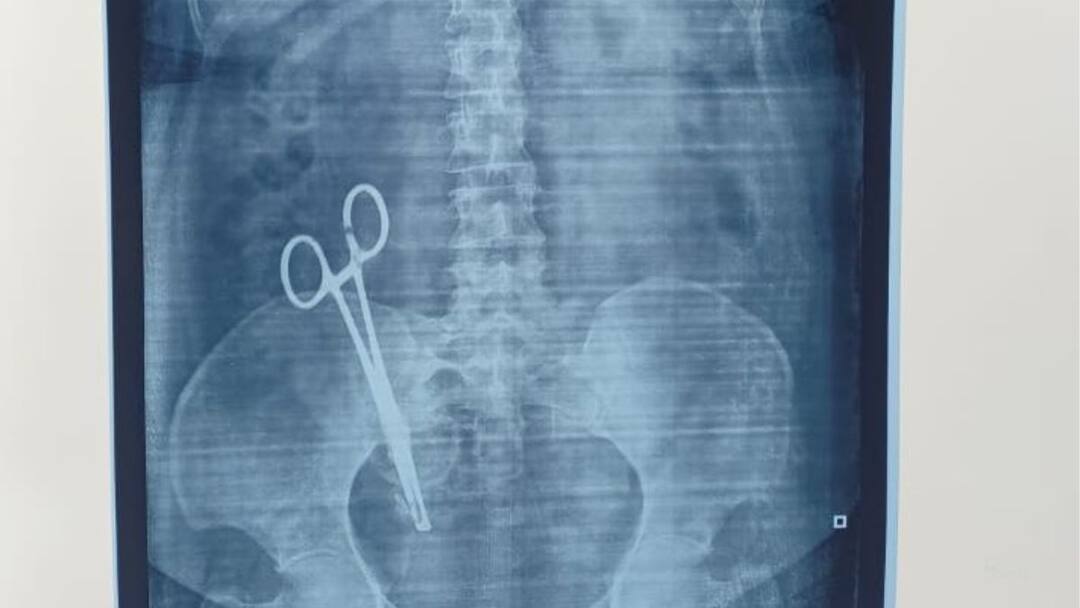 Scissor in Stomach: இப்படி ஒரு டாக்டரா..! உ.பி., மக்கள் ஷாக், 17 வருடங்களாக வயிற்றில் கத்திரிக்கோல்..