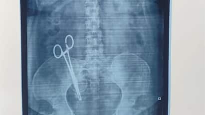 Scissors left in woman’s stomach detected after 17 years Gross medical negligence Scissor in Stomach: இப்படி ஒரு டாக்டரா..! உ.பி., மக்கள் ஷாக், 17 வருடங்களாக வயிற்றில் கத்திரிக்கோல்..