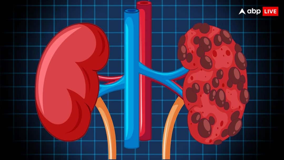 health tips how stones form in human body know most dangerous stone इंसान के शरीर में कैसे बन जाती हैं पथरियां, कौन सी पथरी होती है सबसे खतरनाक?