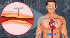 શરીરના આ હિસ્સામાં થઇ રહ્યું છે દર્દ તો સમજી જજો વધી રહ્યું છે કોલેસ્ટ્રોલ
