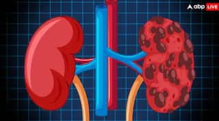 ਮਨੁੱਖ ਦੇ ਸਰੀਰ ‘ਚ ਕਿਵੇਂ ਬਣਦੀ ਪੱਥਰੀ, ਕਿਹੜੀ ਹੁੰਦੀ ਸਭ ਤੋਂ ਵੱਧ ਖਤਰਨਾਕ? ਇੱਥੇ ਜਾਣੋ