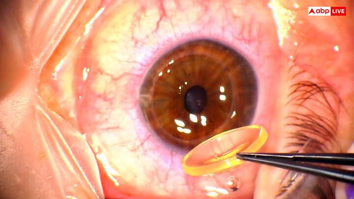 How is corneal transplant surgery? - For this surgery of the eye, the patient is first given local or general anesthesia. The doctors then remove the patient's damage cornea and apply a healthy cornea of the donor accurately. It is then sealed with stitches, which dissolve over time or remove the doctor. This surgery takes about 1-2 hours and the patient is soon sent home.